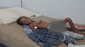 Ratih Yulita Penderita Gizi Buruk Butuh Bantuan