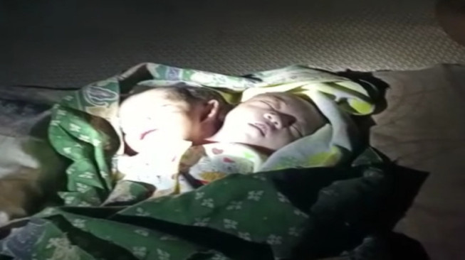 Bayi Terlahir Satu Tubuh, Dua Kepala