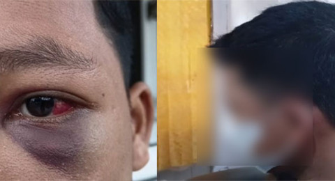 Santri Diduga Dianiaya Guru, Sempat Pingsan dan Mata Bengkak