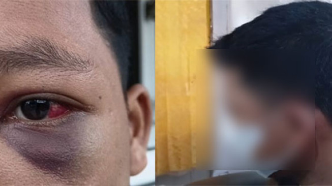 Santri Diduga Dianiaya Guru, Sempat Pingsan dan Mata Bengkak